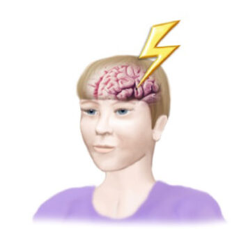 Illustrative depiction of a patient having a stroke or TIA